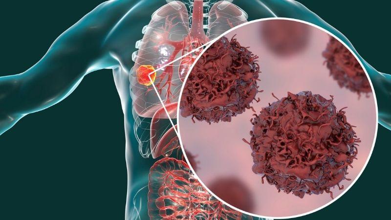 Bối mẫu giúp hỗ trợ điều trị ung thư phổi